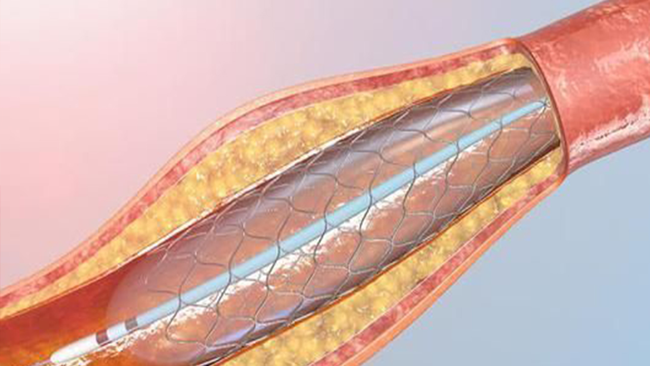 國家組織冠脈支架集采接續(xù)采購開標(biāo)，價格總體平穩(wěn)—— 產(chǎn)品更加豐富  供應(yīng)更